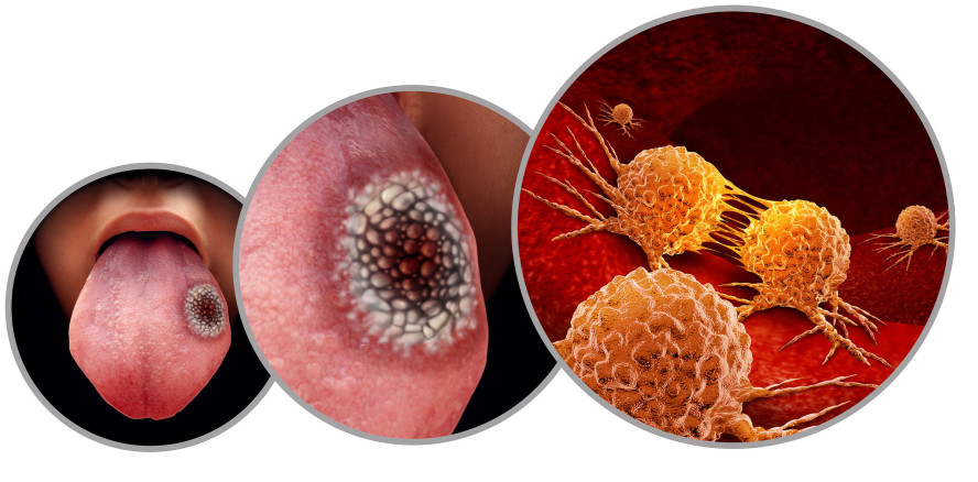 Mundhöhlenkrebs: Relevanz einer frühzeitigen Diagnose