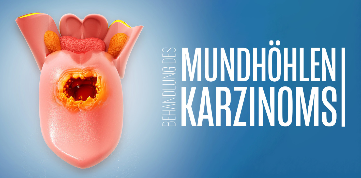 Innovative Ansätze zur Behandlung des Mundhöhlenkarzinoms