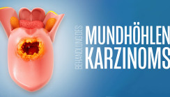 Innovative Ansätze zur Behandlung des Mundhöhlenkarzinoms
