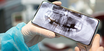 Mundkrebs-Früherkennung mit dem Handy: Forscher testen neues Diagnoseverfahren