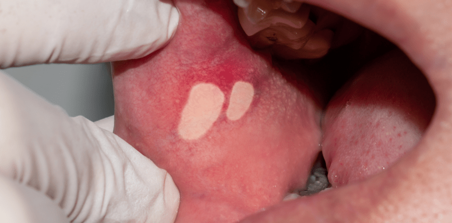 Mundkrebs: Neue Erkenntnisse zur Tumorentstehung