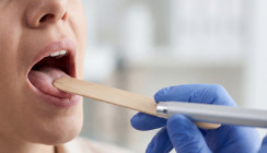 Mundsoor bei Erwachsenen: Woher er kommt und was hilft