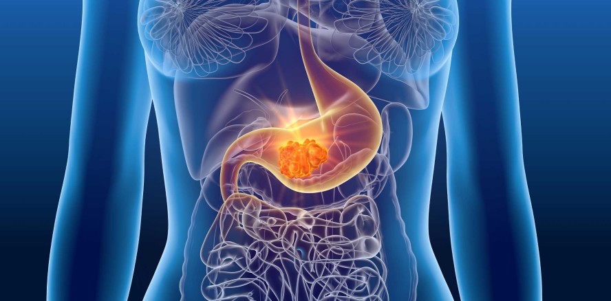 Mundspülung als Früherkennung bei Magenkrebs?