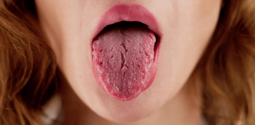 Mundtrockenheit ernst nehmen – Unterschätzte Folgen für Zähne und Allgemeingesundheit