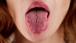 Mundtrockenheit ernst nehmen – Unterschätzte Folgen für Zähne und Allgemeingesundheit