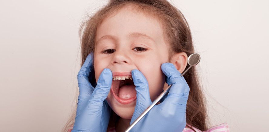 Drastischer Anstieg von Zahnextraktionen bei Kindern