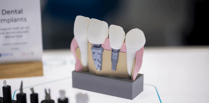 Neuartiges Zahnimplantat: Innovative Prozesskette für patientenspezifischen Zahnersatz