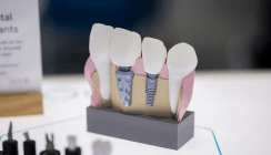 Neuartiges Zahnimplantat: Innovative Prozesskette für patientenspezifischen Zahnersatz