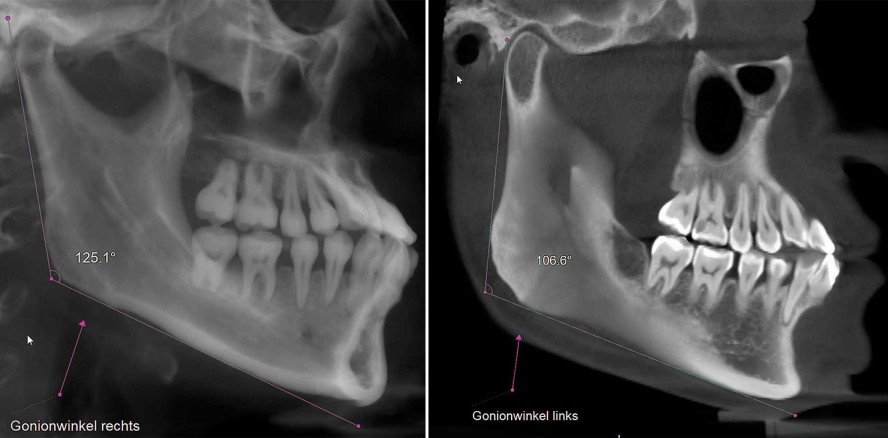 Fallbericht: Neue Grenzen der Alignertherapie (Teil 2)