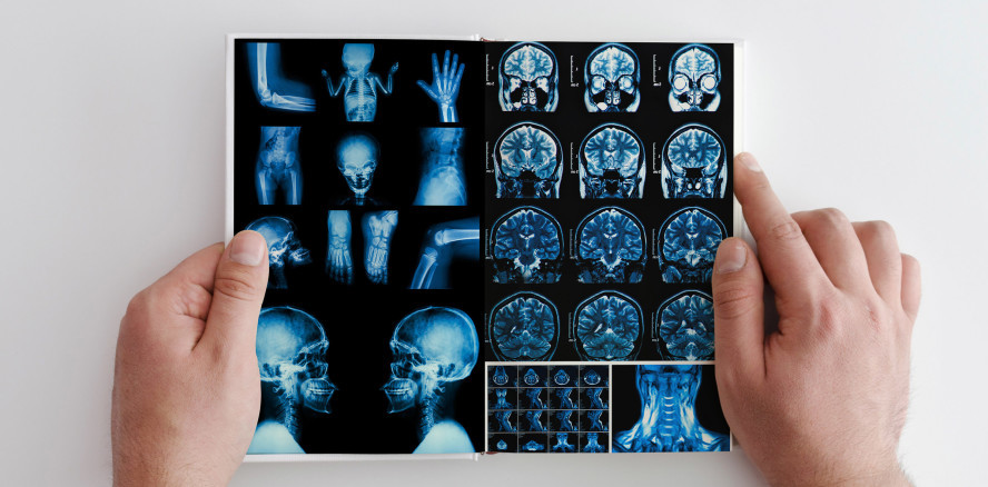 Neue Studie: Bei Kopf-Hals-Tumoren Überlebenschancen steigern