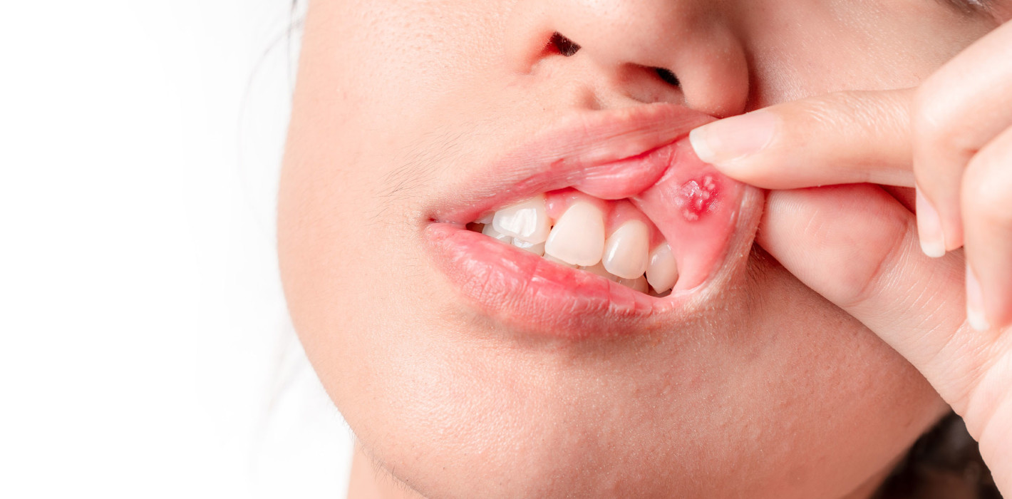 Oraler Lichen planus: Neuartiges Klebepflaster zur Behandlung