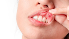 Oraler Lichen planus: Neuartiges Klebepflaster zur Behandlung
