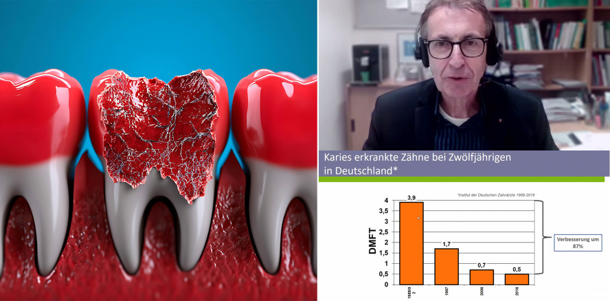 Erfolge in der Kariesvorbeugung – Fluoride bleiben unverzichtbar