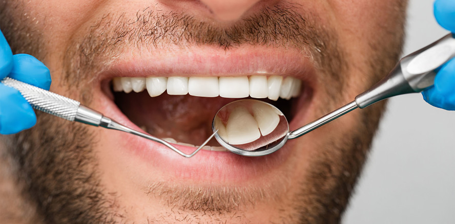 Parodontitis erhöht das Risiko für Schlaganfall und Bluthochdruck