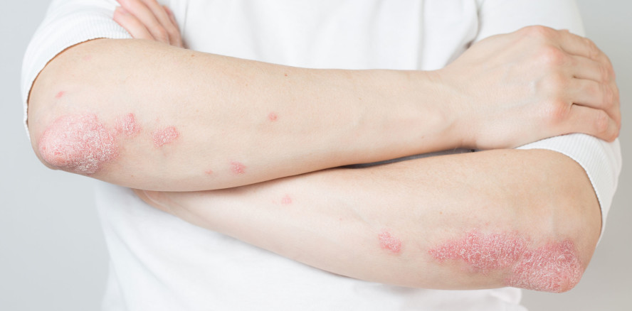 Parodontitis bei Patienten mit Psoriasis und Psoriasis-Arthritis