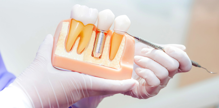 Parodontitis und Periimplantitis in der Implantologie