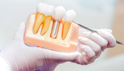 Parodontitis und Periimplantitis in der Implantologie