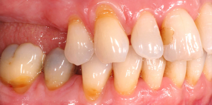 Schwere Parodontalerkrankungen: Klinische Behandlungskonzepte