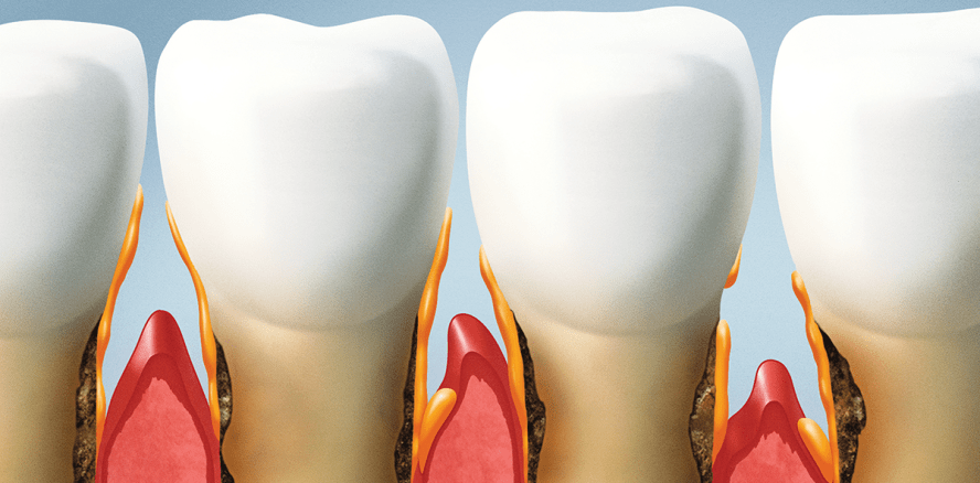Heute ist Europäischer Tag der Parodontologie