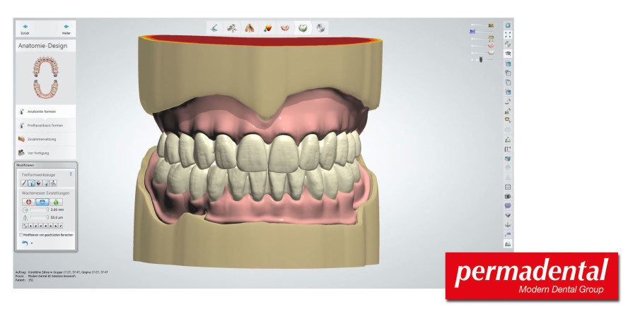 EVO-Denture – das digitale Highlight in der Totalprothetik