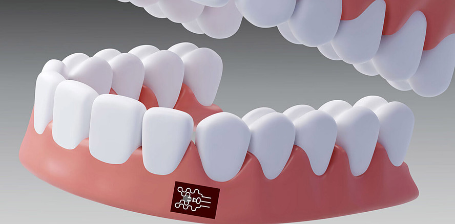 Statt Sonde & Co.? Neues Pflaster soll Parodontitis erkennen