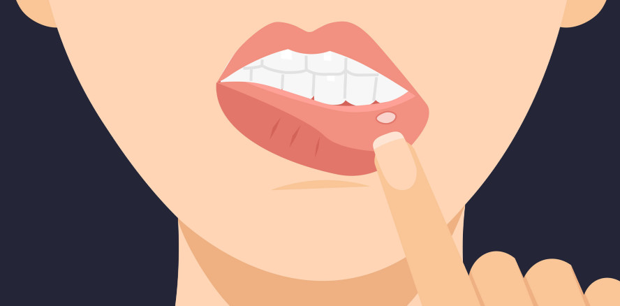 Bläschen im Mund? Wenn sich Aphthen wie “Pickel“ anfühlen