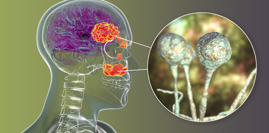 Schwarzer Pilz: Patient verliert nach Coronainfektion alle Zähne