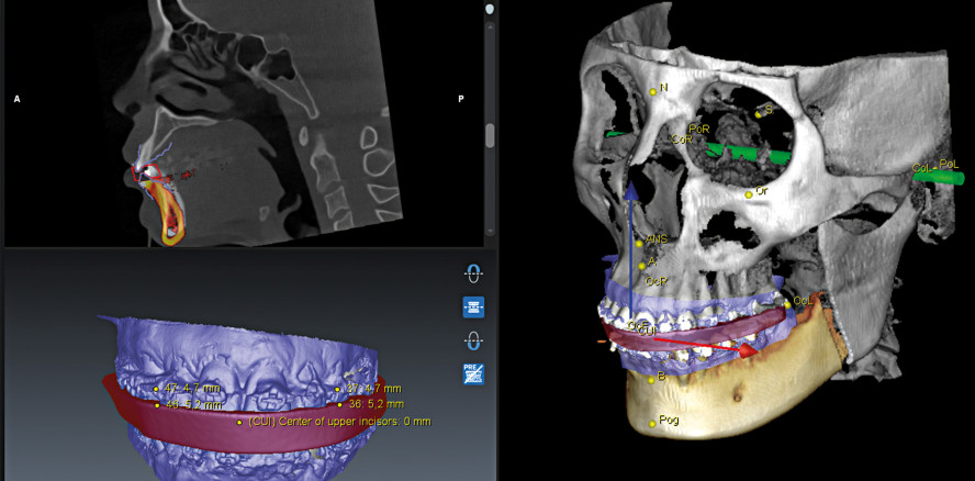Digitale Planung: von Implantation bis Dysgnathie-OP