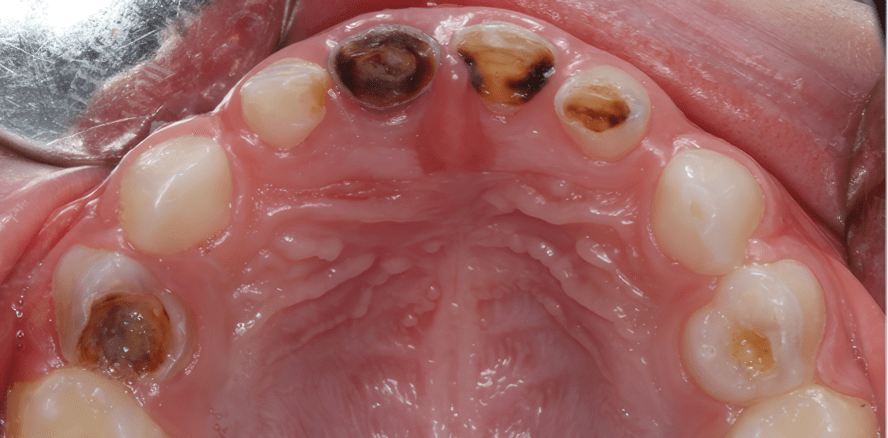 Zur Prävalenz der frühkindlichen Karies und den zahnärztlichen FU