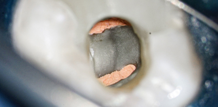 Präparation komplexer Kanalsysteme in Primär- und Sekundärtherapie