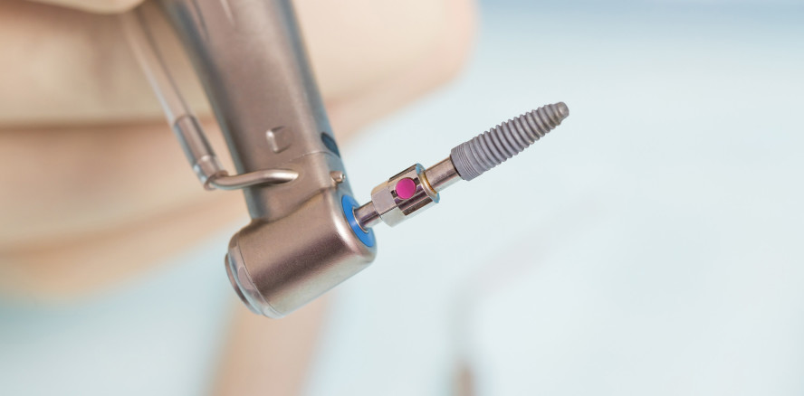 Propolis statt Chlorhexidin? Natürliche Substanzen in der Implantatreinigung