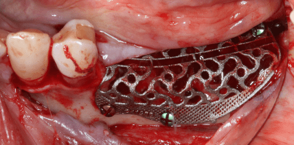 Hyaluronsäure und Polynukleotide bei der Regeneration des Alveolarkamms