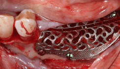 Hyaluronsäure und Polynukleotide bei der Regeneration des Alveolarkamms