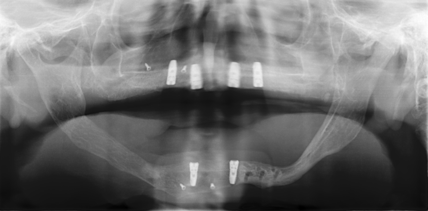 Rehabilitation nach enoralen Malig­nomen & autologer Transplantation