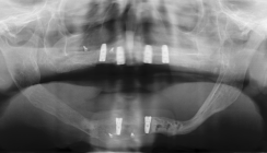 Rehabilitation nach enoralen Malig­nomen & autologer Transplantation