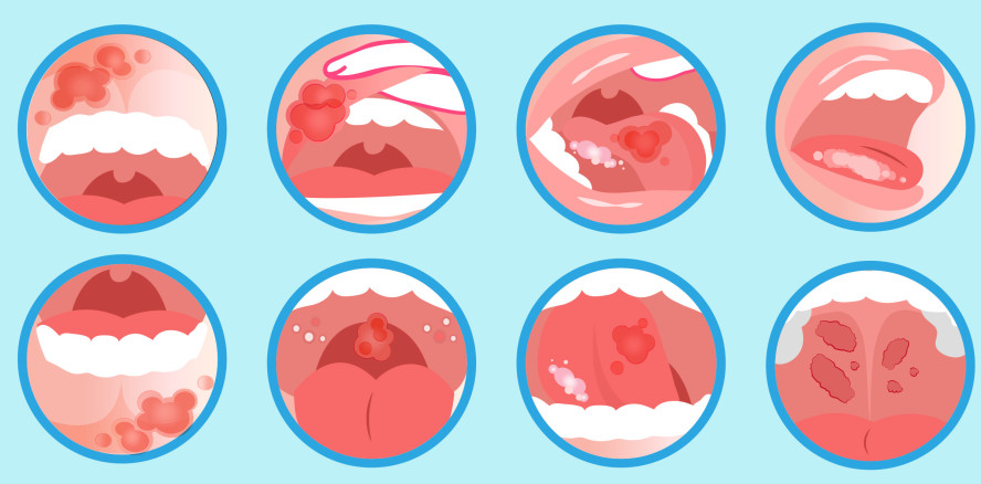 Neues Rekordhoch: Immer mehr Mundkrebsdiagnosen