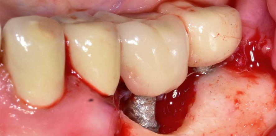 Resektive Periimplantitistherapie bei Morbus Crohn