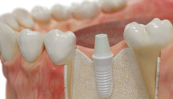 Die Rolle der Implantatoberfläche für die Osseointegration
