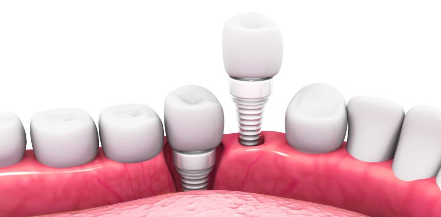 S3-Leitlinie zum Thema Keramikimplantate