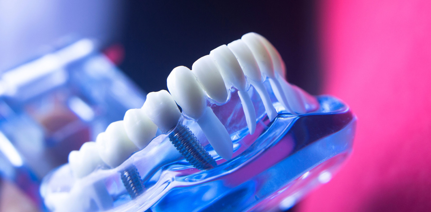 „Implantatversorgung nach Bestrahlung“ – Update der Leitlinie
