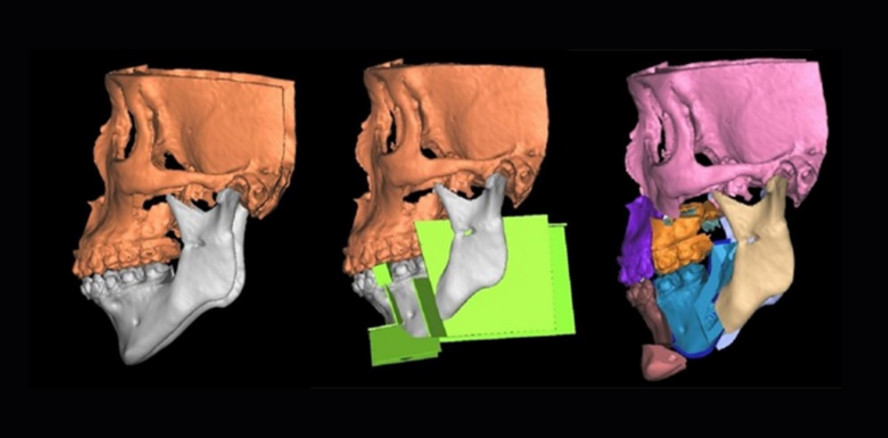 Kieferchirurgie: Behandlung von obstruktiver Schlafapnoe