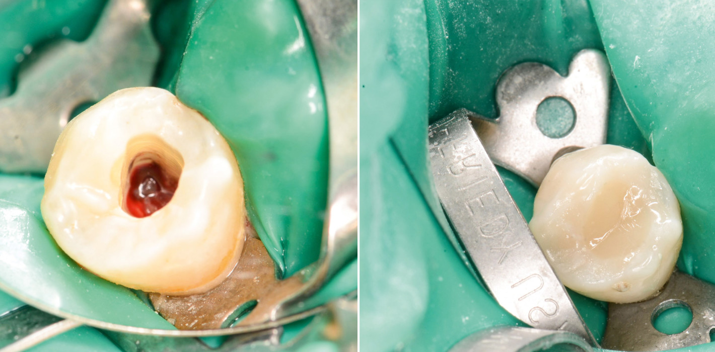 Wurzelkanalbehandlung bei interner Resorption