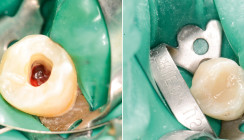 Wurzelkanalbehandlung bei interner Resorption