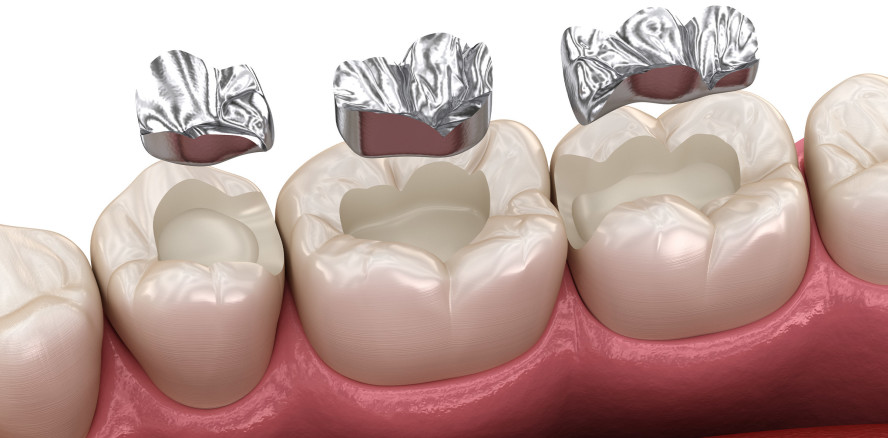 Kinder & Schwangere: Ab Juni 2022 keine Amalgamfüllungen mehr