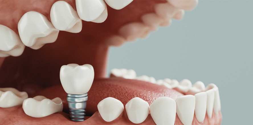 Erkenntnisse zur Sofortimplantation und Knochenregeneration