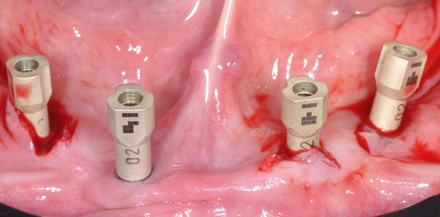 Sofortimplantation und digitale Abformung im zahnlosen UK