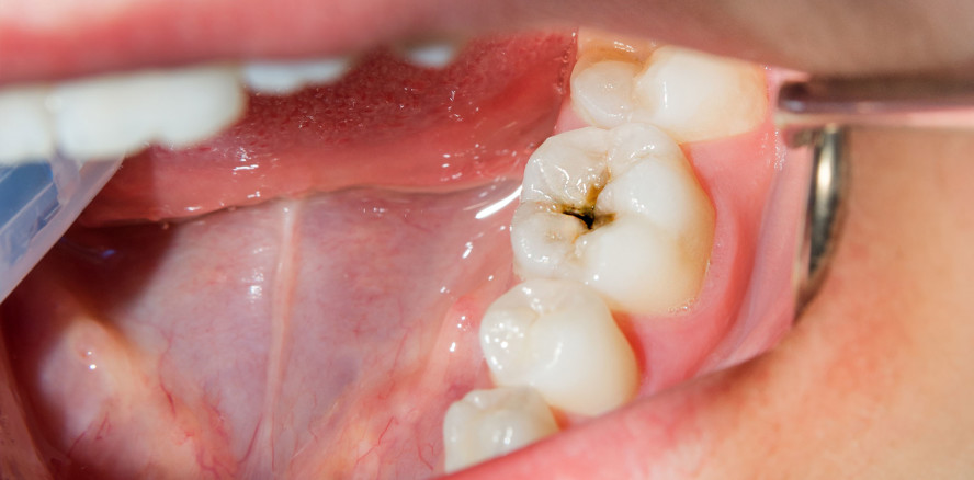 Entschlüsselt: Speichelproteine von Kariespatienten
