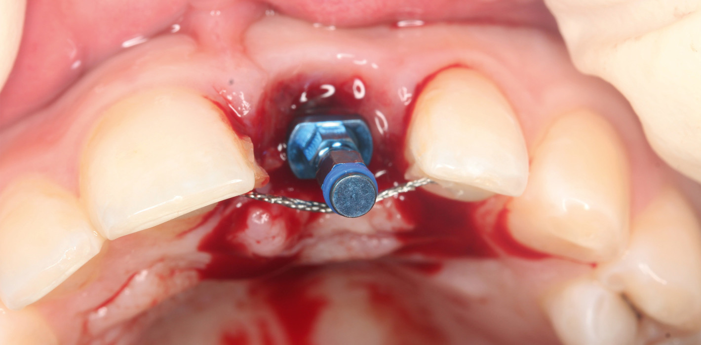 Implantation bei Teenagern in der ästhetischen Zone