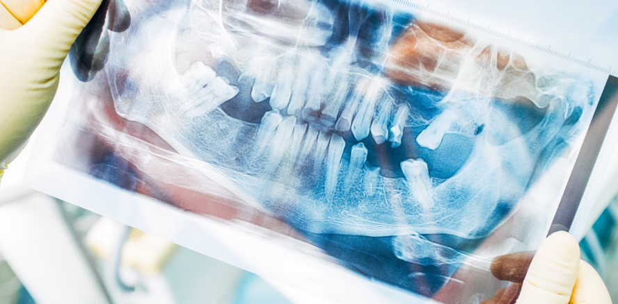 Steigender Punktwert für Zahnersatz und Kronen