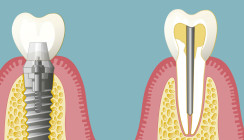 Stiftzahn oder Implantat – wo ist der Unterschied?